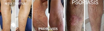 Homeopathic treatment for psoriasis

